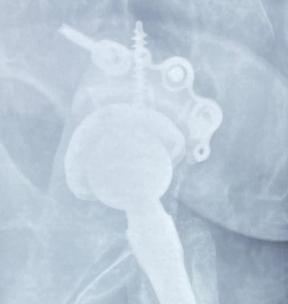 Post-operative bose augment x-ray