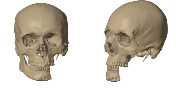 1:1 digital model of the mandible