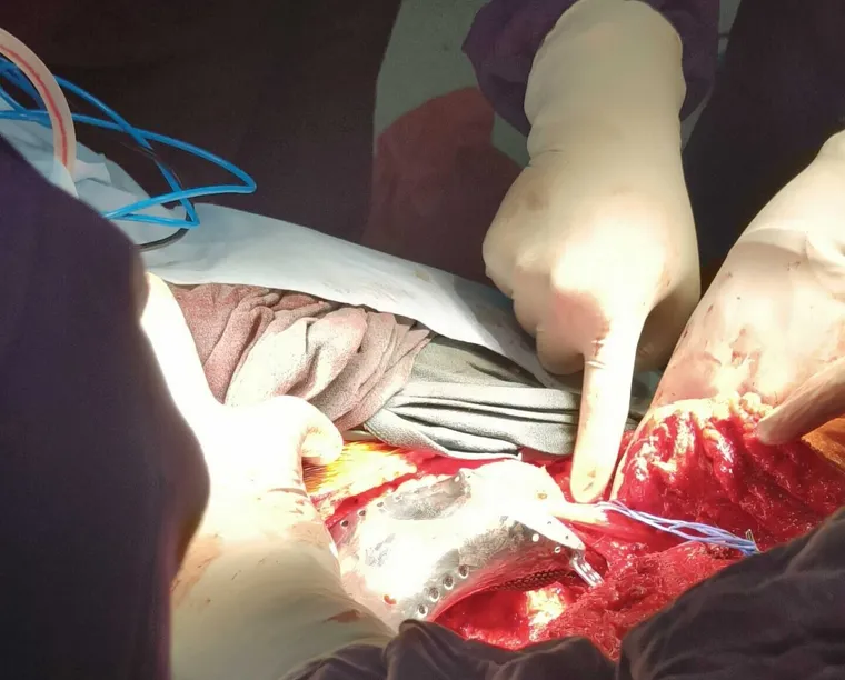 Intraoperative view