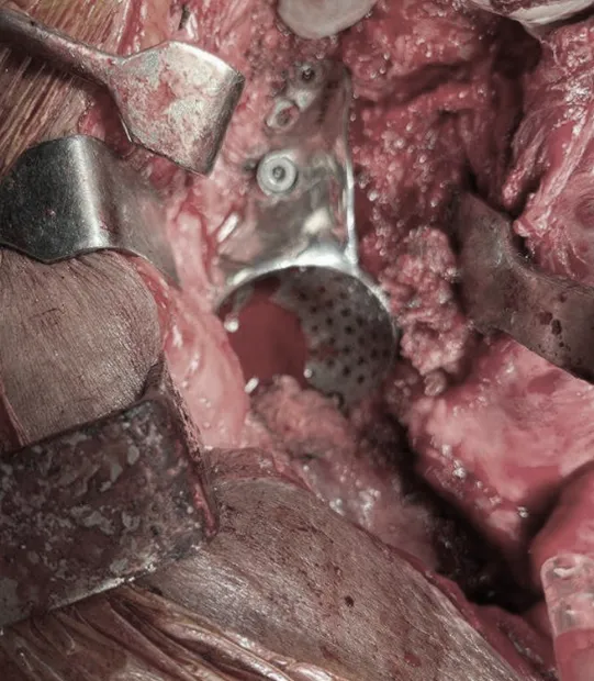 Implant in position