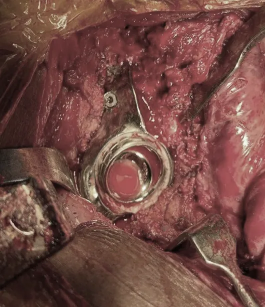 Intra-operative image