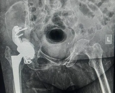 Postoperative result