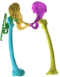1:1 digital model of the hip defect