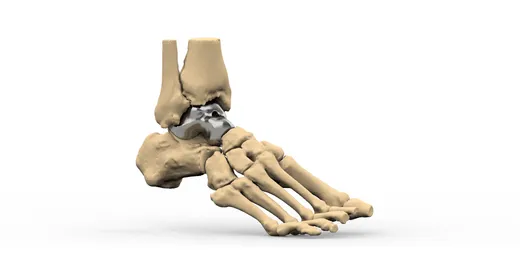 Patient-specific total talus replacement