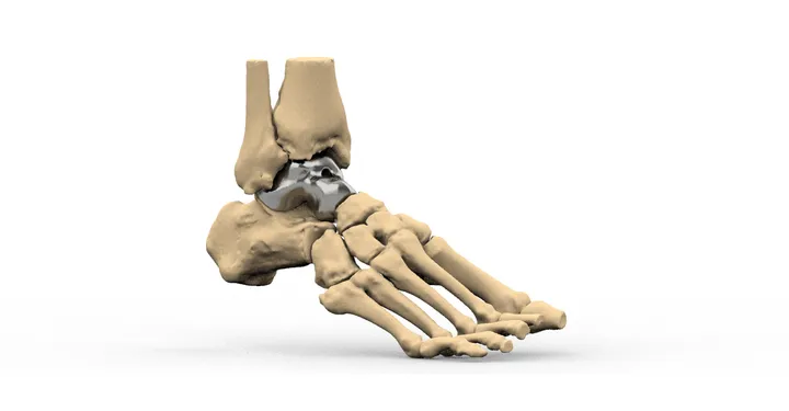 Patient-specific total talus replacement