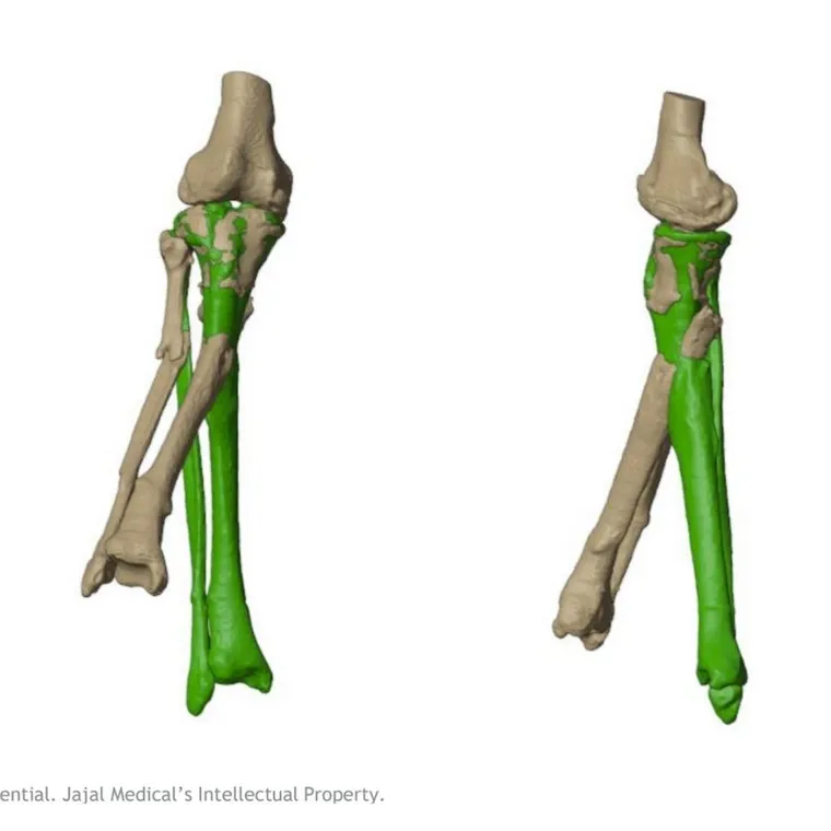 Segmentation of both tibias