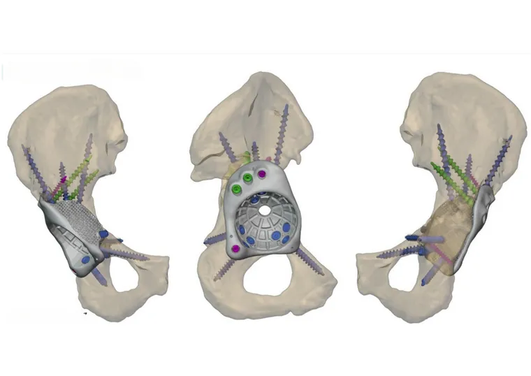Patient-specific FTL cup engineered to the defect morphology