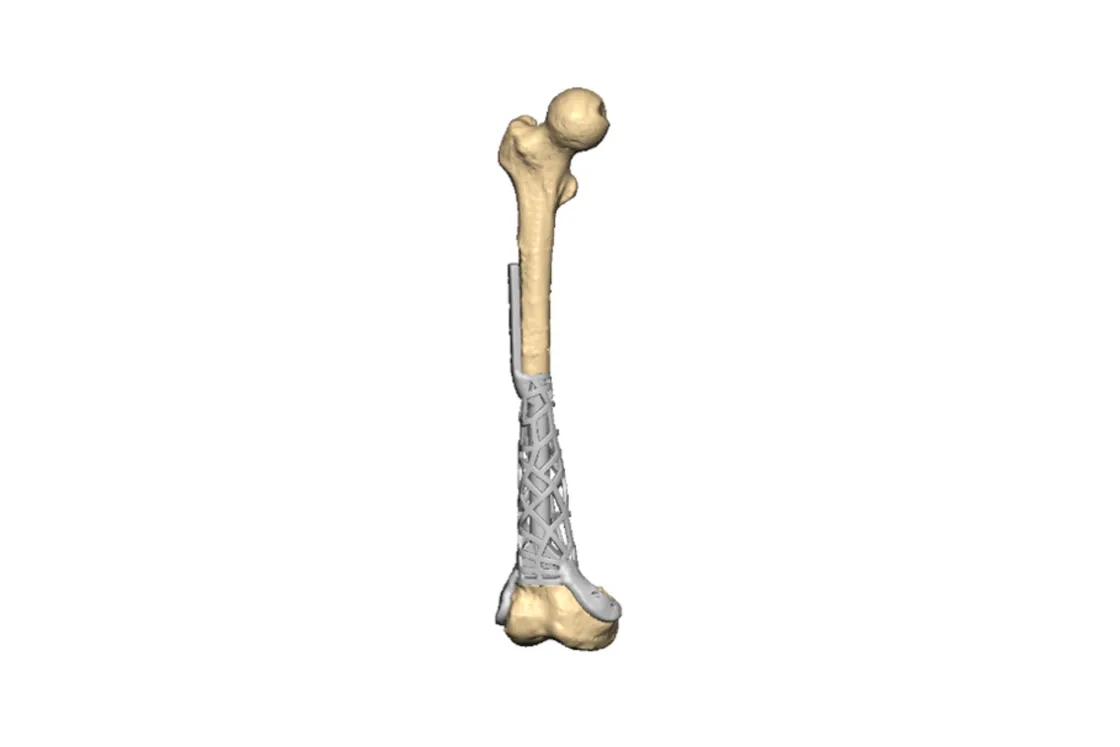 Custom intramedullary distal femur implant