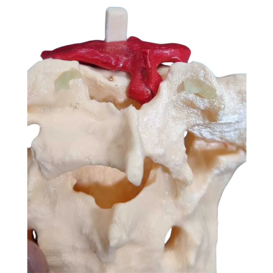 3D-printed lumbar spine surgical model