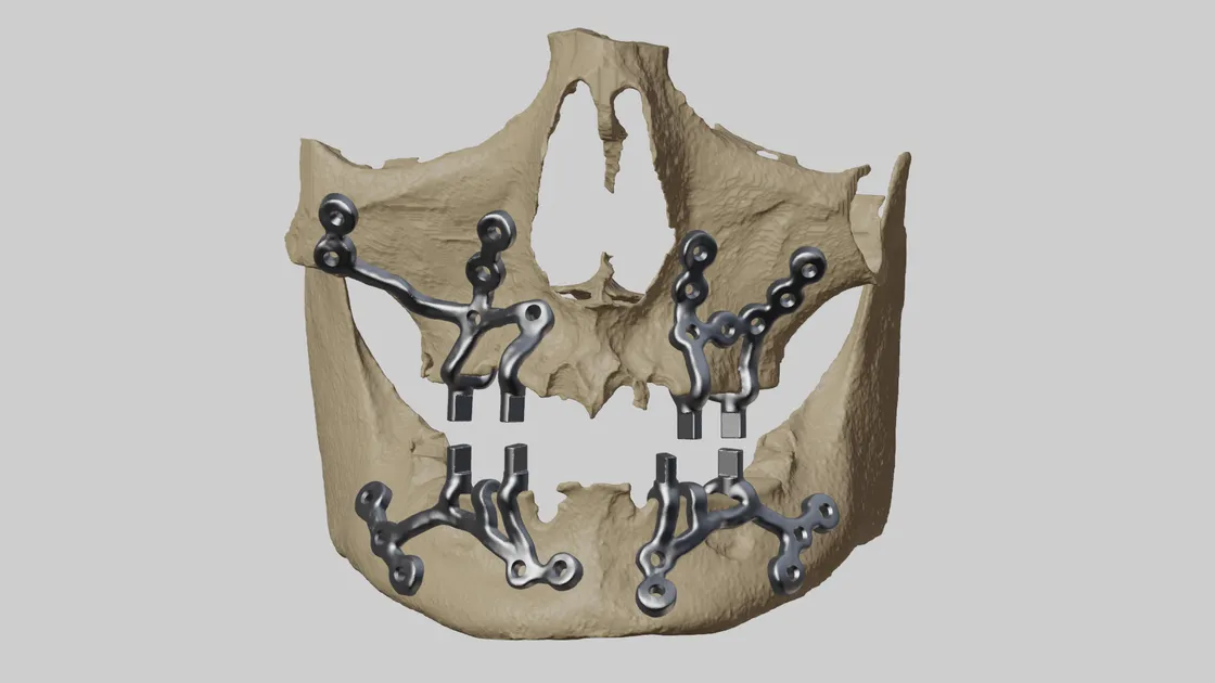 Custom titanium subperiosteal implants for maxilla and mandible