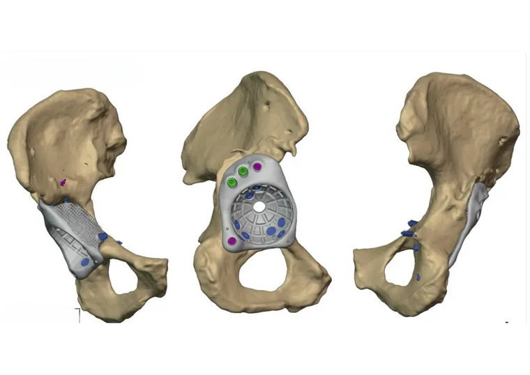 Massive bone loss in the anterior column of the right acetabulum