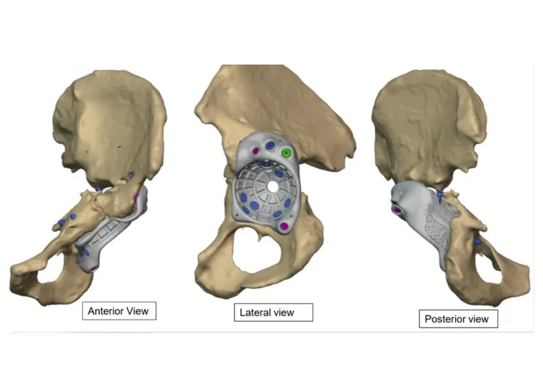 Multi-flange fixation