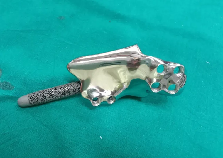 Printed titanium tibia implant