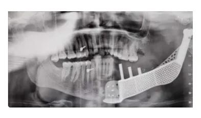 Printed implant and guides