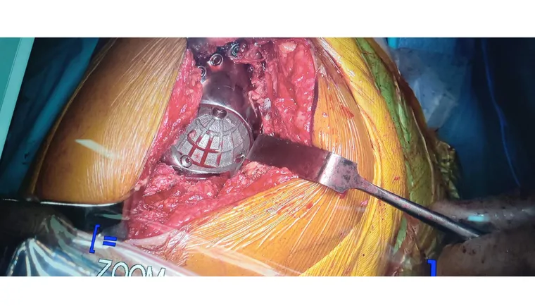 Postoperative imaging