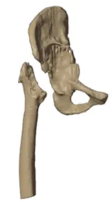 Damaged acetabulum and femoral head