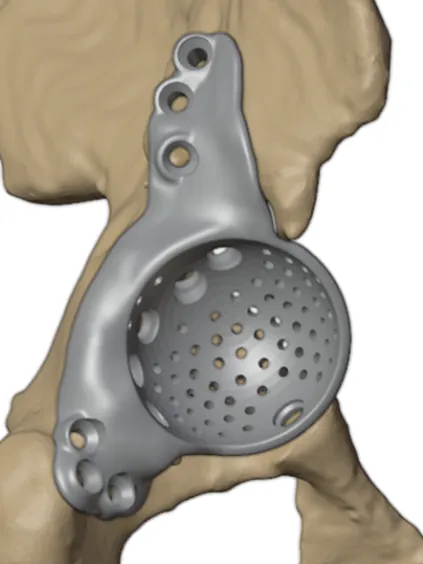 Mirrored implant design
