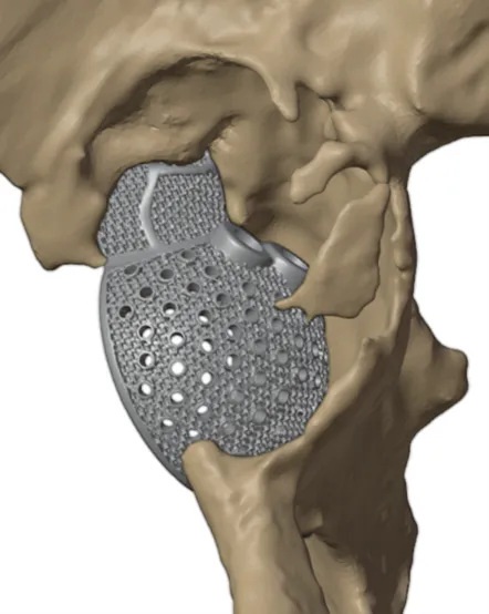 Cage implant covering the defect