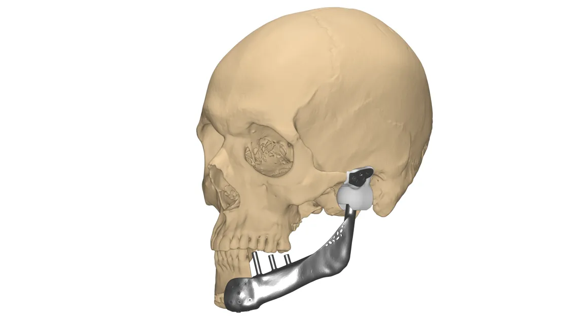 Custom total TMJ implant with titanium body and UHMWPE fossa