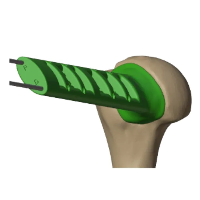 Patient-specific drilling guide in the lesion