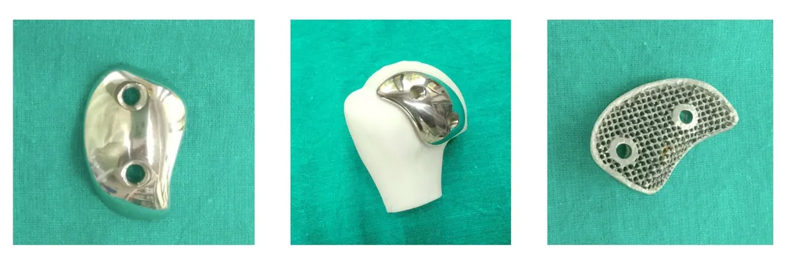 Custom Hill-Sachs implant for a large humeral head lesion