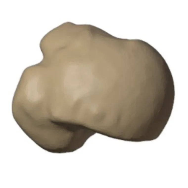 Preoperative imaging of the humeral head defect