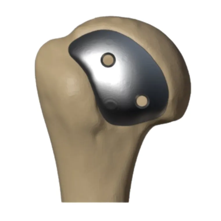 Defect geometry beyond standard dome implants