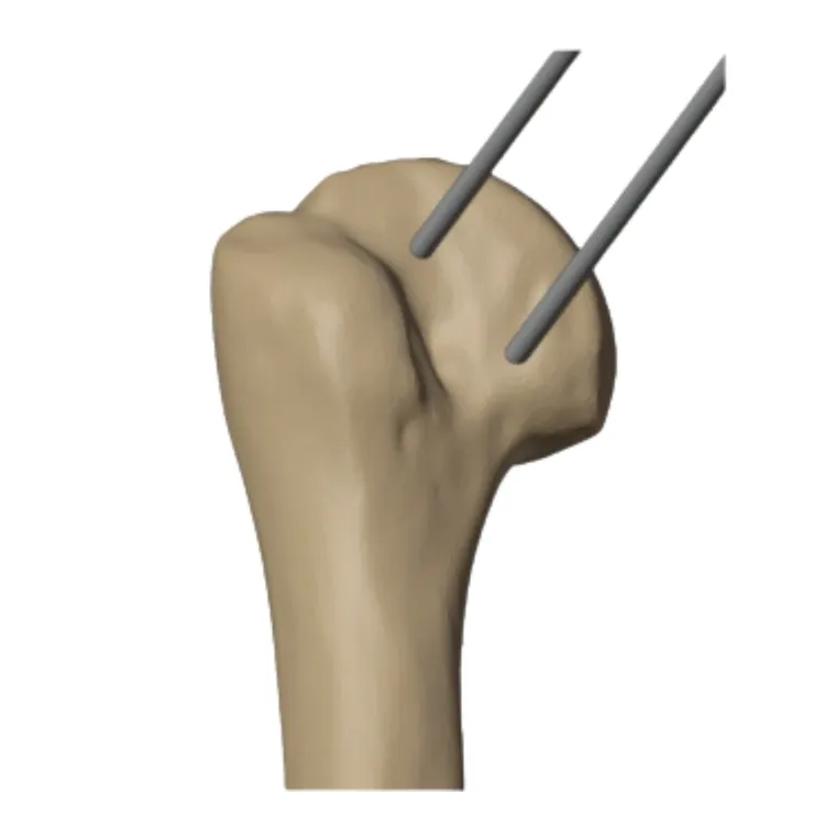 Parallel K-wire placement