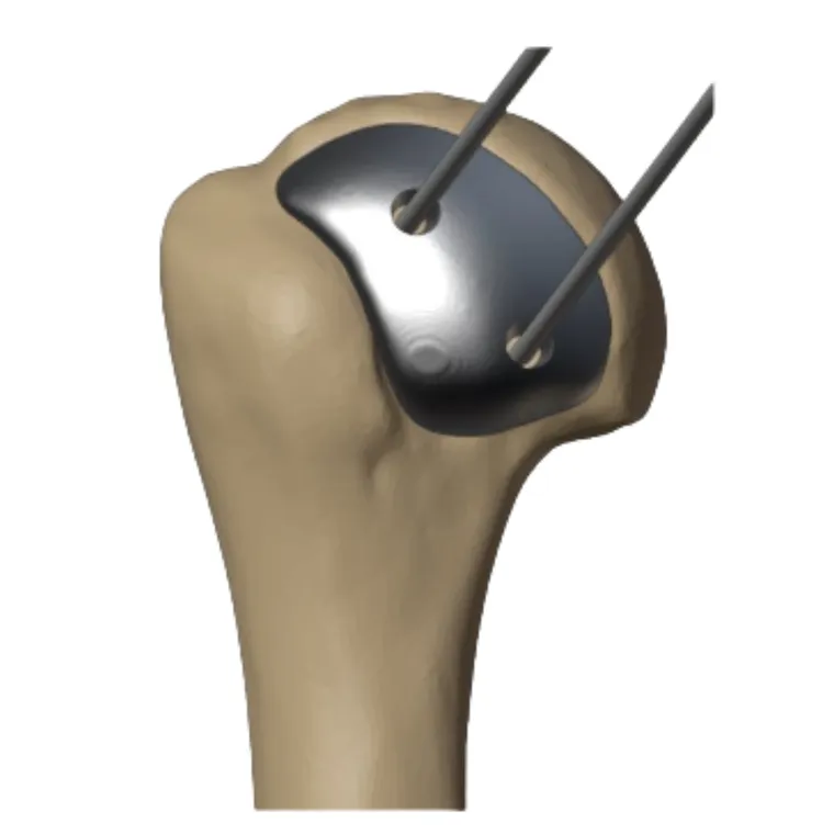 Implant orientation set by the wires