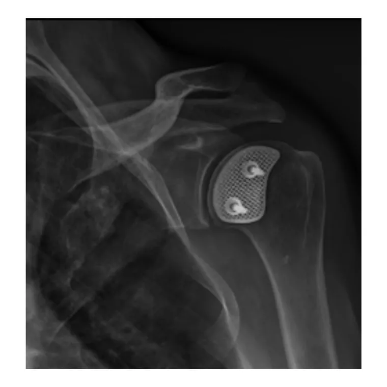 Restored humeral head contour
