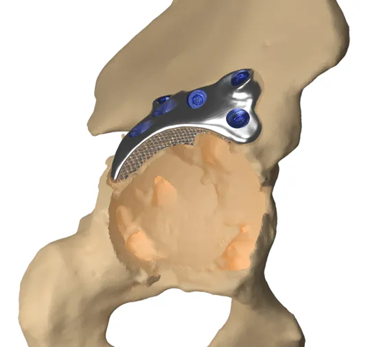 Bose custom columnar docking augment for revision hip