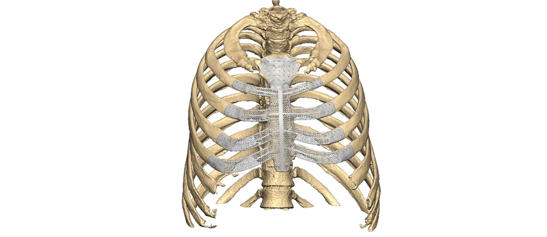 Custom single-component sternum-ribs titanium implant