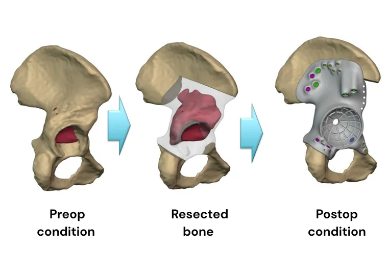 CT-based 3D segmentation and resection planning