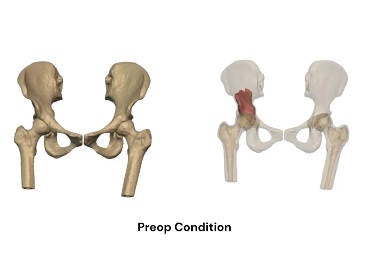 Preoperative imaging of the pelvic tumour
