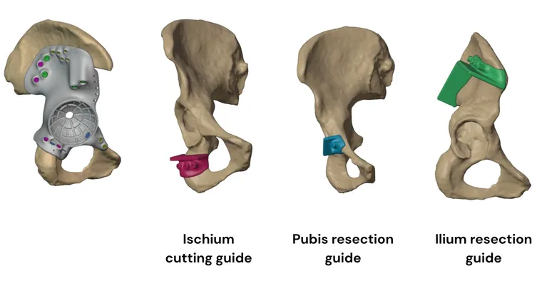 FTL cup implant with model and jigs