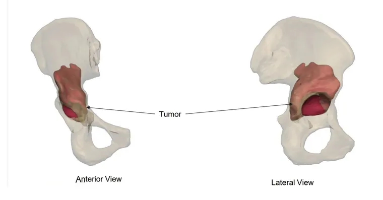 Extent of the acetabular defect