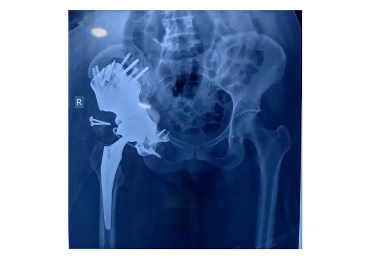 Postoperative imaging