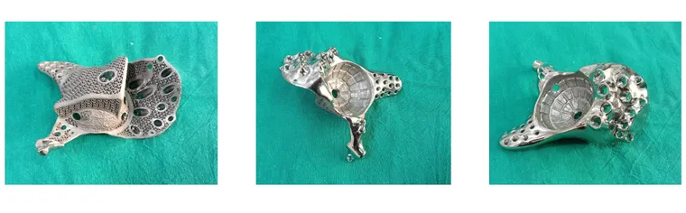 Implant detail