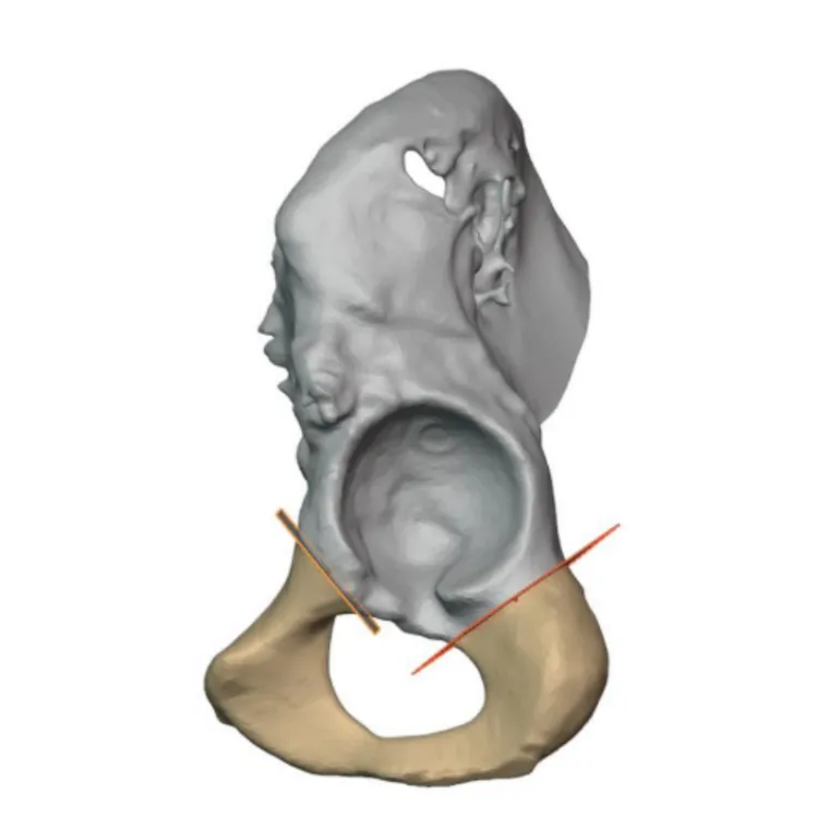 Resection planning