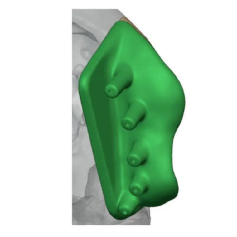 Implant positioning