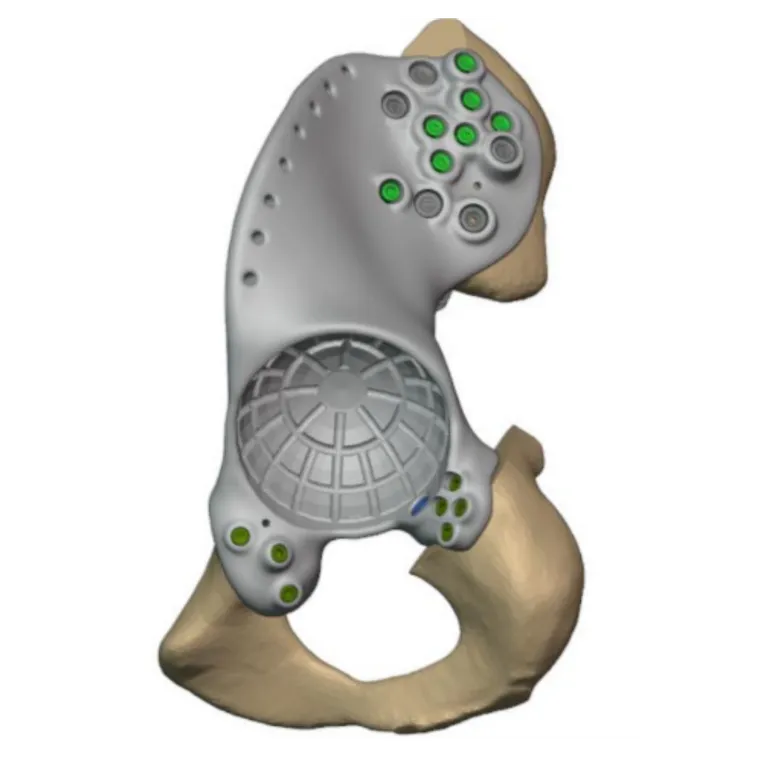 Custom hemipelvic implant