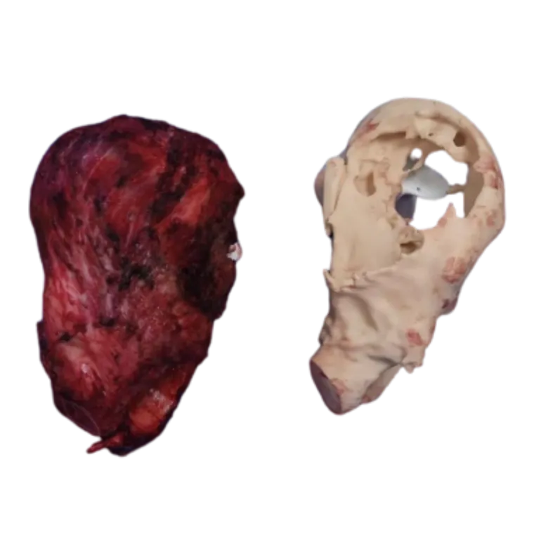 En bloc resection