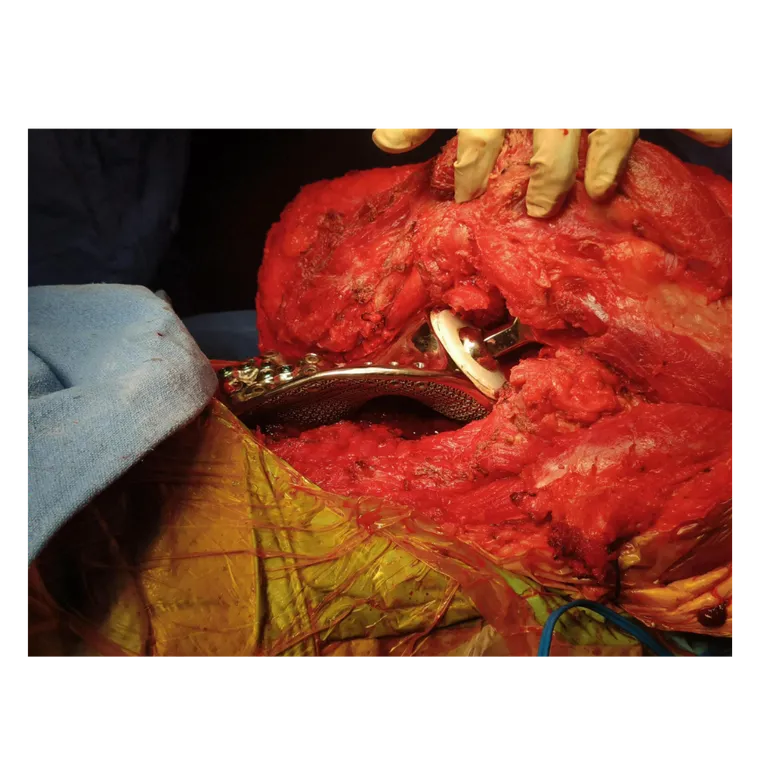 Screw fixation