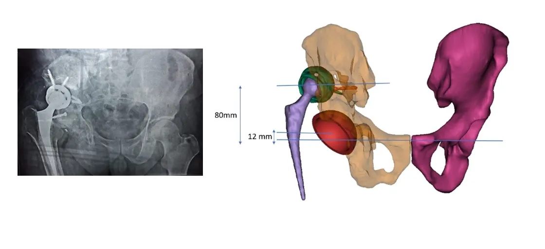 Complex hip revision 3D reconstruction