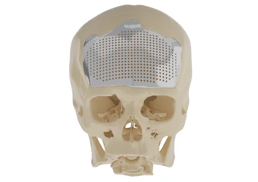 Titanium Cranial Implant