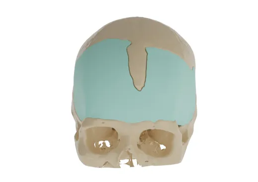 PMMA Cranial Implant