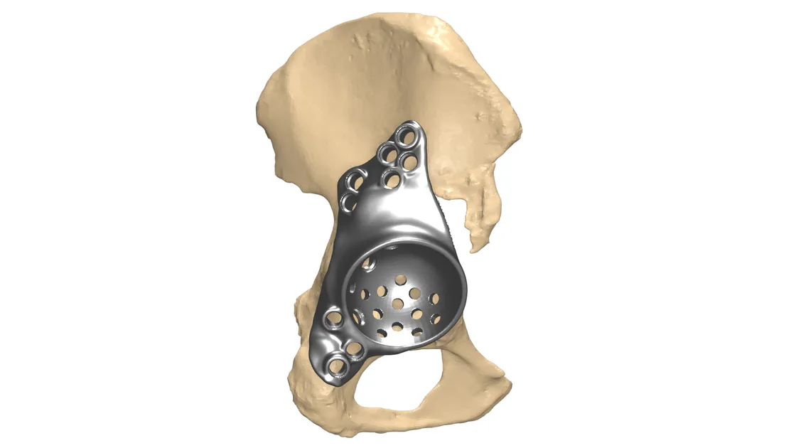 Custom revision hip biflange cage implant