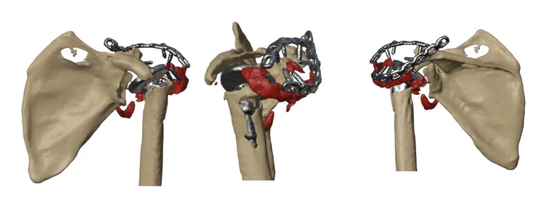 Failed implant and glenoid bone loss