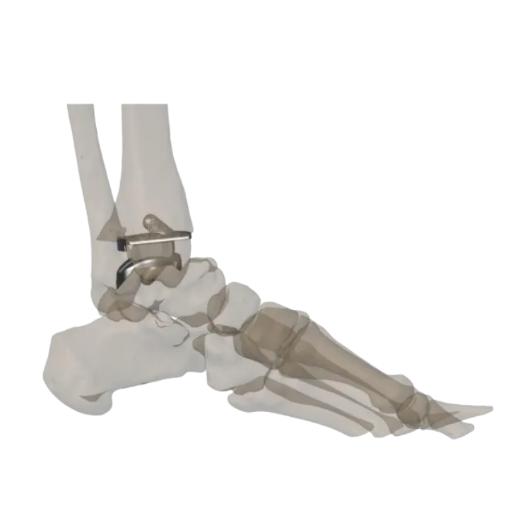 Custom 3D-printed total ankle replacement implant