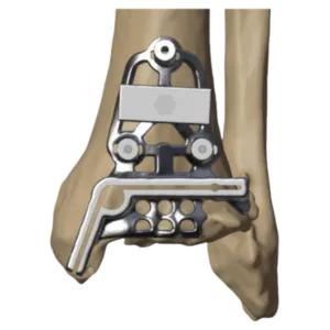 Tibial resection